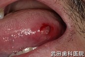 府中市の歯医者 武田歯科の口腔外科事例【舌咬傷】治療前