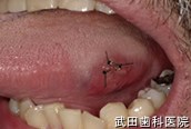 府中市の歯医者 武田歯科の口腔外科事例【舌咬傷】治療直後