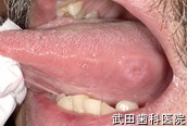 府中市の歯医者 武田歯科の口腔外科事例【舌咬傷】治療1週間後