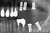 府中市の歯医者 口腔外科専門医　武田歯科のインプラント事例【左上457,左下67インプラント埋入】埋入後