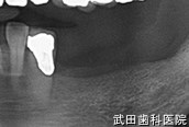 府中市の歯医者 口腔外科専門医　武田歯科のインプラント事例【左上4,5,6インプラント埋入】治療前