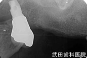 府中市の歯医者 口腔外科専門医　武田歯科のインプラント事例【右上7インプラント埋入】上部構造セット後