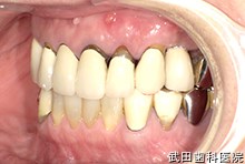 府中市の歯医者 口腔外科専門医　武田歯科のインプラント事例【左上4インプラント埋入】上部構造セット後