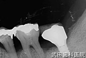 府中市の歯医者 口腔外科専門医　武田歯科のインプラント事例【左下7インプラント埋入】上部構造セット後