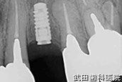 府中市の歯医者 口腔外科専門医　武田歯科のインプラント事例【左上4インプラント埋入】埋入後