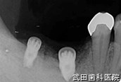 府中市の歯医者 口腔外科専門医　武田歯科のインプラント事例【右下6、7抜歯即時埋入】埋入後