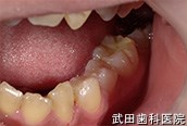 府中市の歯医者 武田歯科の審美歯科事例【左下4審美修復】術後