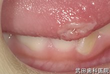 府中市の歯医者 武田歯科の外傷事例【舌咬傷】治療前