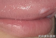 府中市の歯医者 武田歯科の外傷事例【舌咬傷】治療後