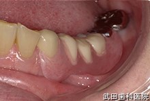 府中市の歯医者 武田歯科の
義歯の事例【ノンクラスプ義歯】ノンクラスプ義歯装着後