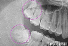 府中市の歯医者 武田歯科の抜歯事例【右下親知らず抜歯】CT画像