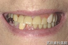 府中市の歯医者 武田歯科の
義歯の事例【非対称の改善】旧義歯装着時