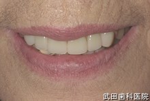 府中市の歯医者 武田歯科の
義歯の事例【非対称の改善】新義歯装着後