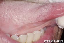 府中市の歯医者 口腔外科専門医　武田歯科 右舌がん