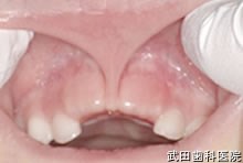 府中市の歯医者 口腔外科専門医　武田歯科の口腔外科 上唇小帯付着異常
