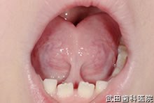 府中市の歯医者 口腔外科専門医　武田歯科の口腔外科 舌小帯付着異常