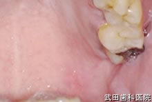府中市の歯医者 口腔外科専門医　武田歯科 白色海綿状母斑