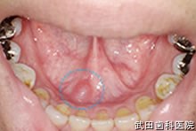 府中市の歯医者 口腔外科専門医　武田歯科の口腔外科事例 下顎前歯舌側唾液腺のう胞