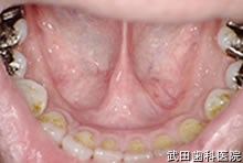 府中市の歯医者 口腔外科専門医　武田歯科の口腔外科事例 下顎前歯舌側唾液腺のう胞