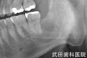 府中市の歯医者 口腔外科専門医　武田歯科の口腔外科事例 左下顎歯原性のう胞
