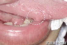 府中市の歯医者 口腔外科専門医　武田歯科 右舌側縁部ポリープ