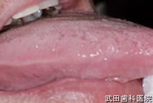 府中市の歯医者 口腔外科専門医　武田歯科 右舌側縁部ポリープ