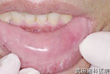 府中市の歯医者 口腔外科専門医　武田歯科の口腔外科事例 下唇粘液のう胞