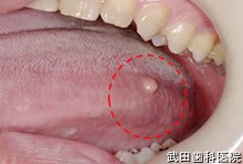 府中市の歯医者 口腔外科専門医　武田歯科 左舌側縁部　脂肪腫