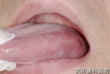 府中市の歯医者 口腔外科専門医　武田歯科 左舌側縁部　脂肪腫