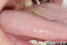 府中市の歯医者 口腔外科専門医　武田歯科 右舌側縁部　乳頭腫