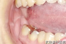 府中市の歯医者 口腔外科専門医　武田歯科 右舌側縁部 疣贅型黄色腫
