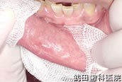 府中市の歯医者 口腔外科専門医　武田歯科の口腔外科事例 下唇粘液のう胞