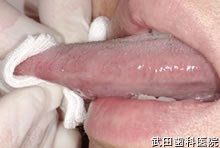 府中市の歯医者 口腔外科専門医　武田歯科 左舌側縁部　乳頭腫
