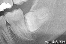府中市の歯医者 武田歯科の親知らず2回法抜歯【左下8】治療前レントゲン写真