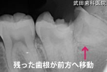 府中市の歯医者 武田歯科の親知らず2回法抜歯【左下8】