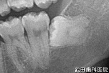 府中市の歯医者 武田歯科の親知らず2回法抜歯【左下8】治療前レントゲン写真