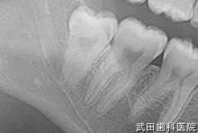 府中市の歯医者 武田歯科の親知らず2回法抜歯【右下8】治療前レントゲン写真