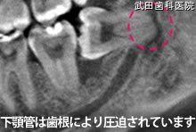 府中市の歯医者 武田歯科の親知らず2回法抜歯【左下8】治療前CT