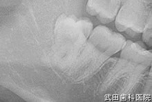 府中市の歯医者 武田歯科の親知らず2回法抜歯【右下8】治療前レントゲン写真