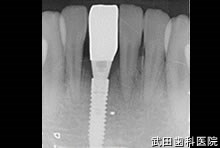 府中市の歯医者 口腔外科専門医　武田歯科のインプラント事例【右下1】上部構造装着

