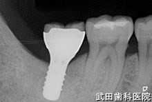 府中市の歯医者 口腔外科専門医　武田歯科のインプラント事例【右下7、左下7 】上部構造装着
