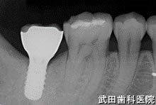 府中市の歯医者 口腔外科専門医　武田歯科のインプラント事例【右下7、左下7 】術後5年経過
