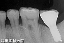 府中市の歯医者 口腔外科専門医　武田歯科のインプラント事例【右下7、左下7 】術後5年経過
