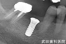 府中市の歯医者 口腔外科専門医　武田歯科のインプラント事例【右下6】インプラント埋入
