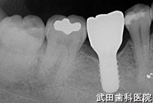 府中市の歯医者 口腔外科専門医　武田歯科のインプラント事例【右下6】術後3年経過
