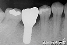 府中市の歯医者 口腔外科専門医　武田歯科のインプラント事例【右下6】上部構造装着

