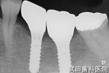 府中市の歯医者 口腔外科専門医　武田歯科のインプラント事例【左下5、6】上部構造装着
