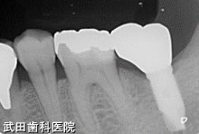 府中市の歯医者 口腔外科専門医　武田歯科のインプラント事例【左下7】術後3年経過
