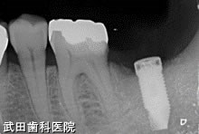 府中市の歯医者 口腔外科専門医　武田歯科のインプラント事例【左下7】インプラント埋入
