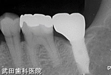 府中市の歯医者 口腔外科専門医　武田歯科のインプラント事例【左下7】上部構造装着
